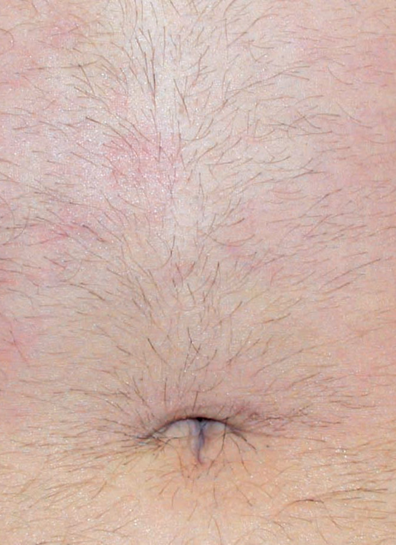 Abdomen Antes