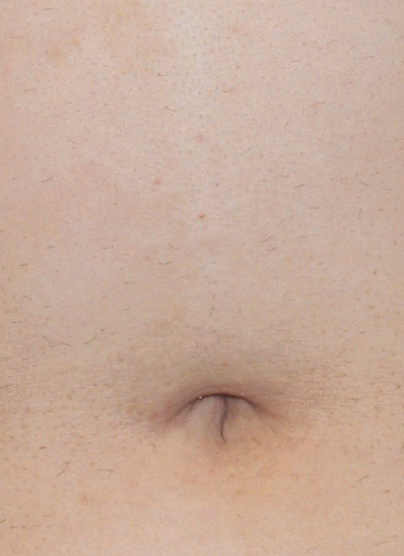 Abdomen Después